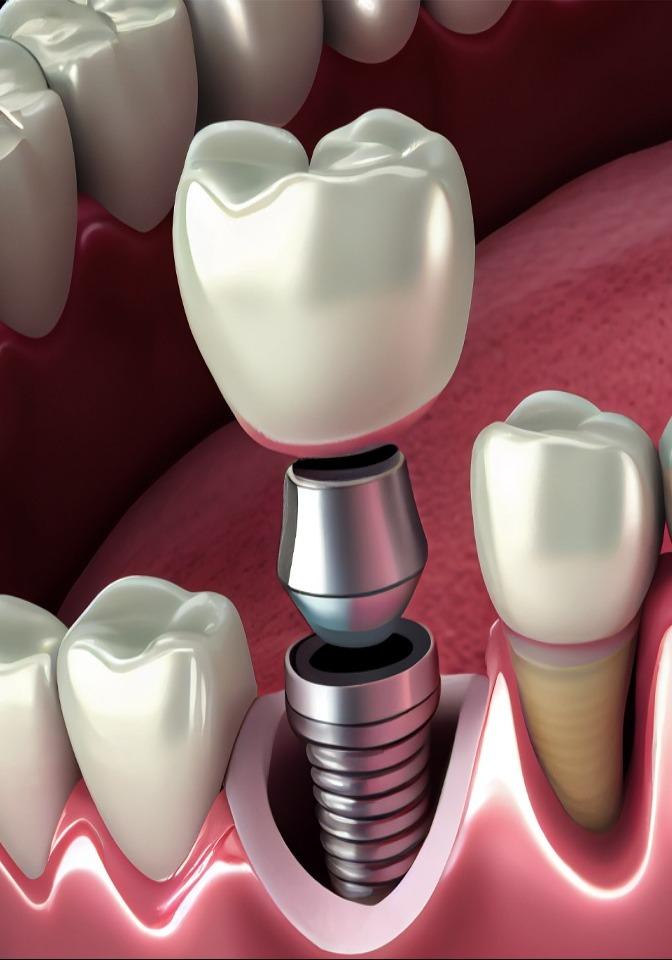 Single-Tooth Dental Implant in Durham
