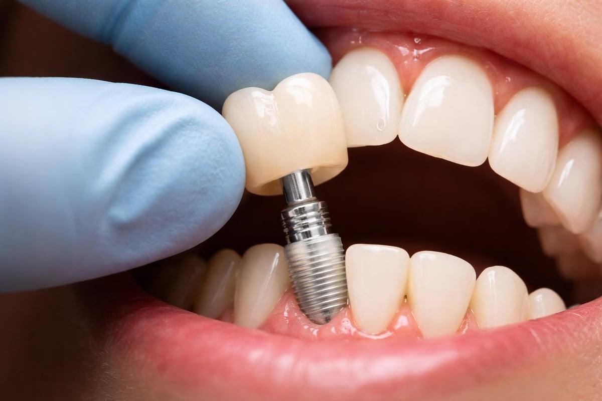 Single-Tooth Dental Implant in Raleigh NC