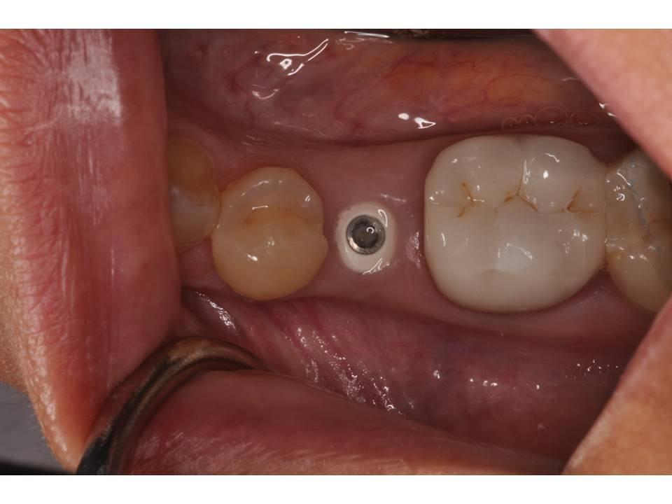Single-Tooth Dental Implants Consultation in North Carolina