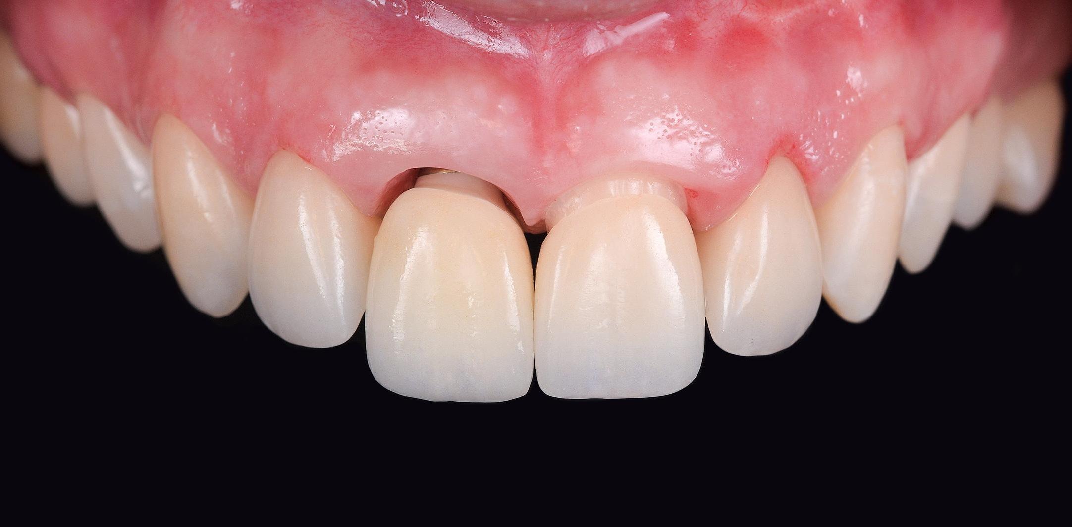Single-Tooth Dental Implants Dentist in Fayetteville NC