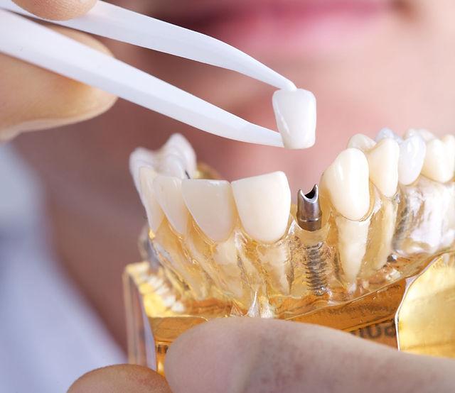 Single-Tooth Dental Implants Dentist in North Carolina