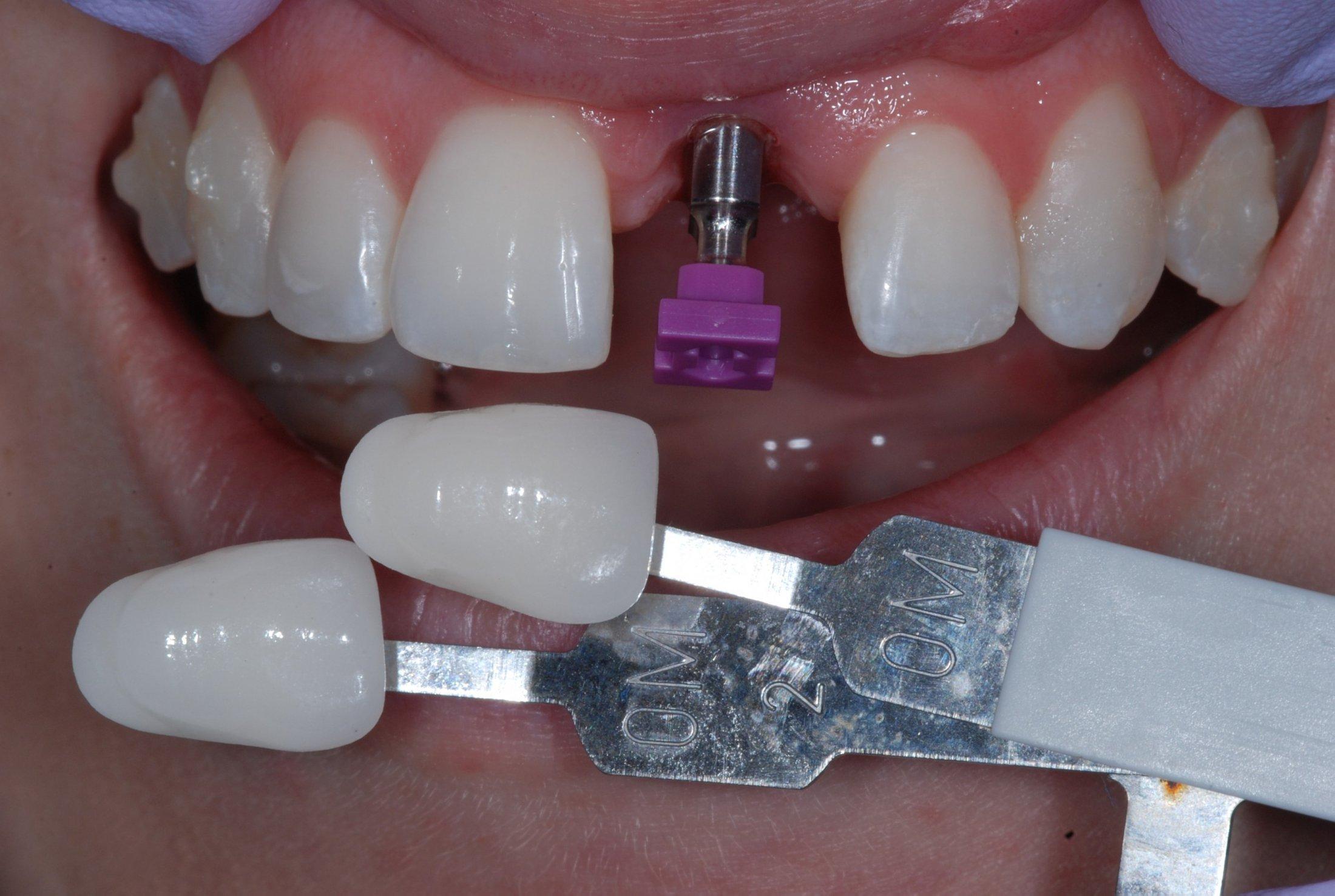Single-Tooth Dental Implants Dentist in Siler City NC