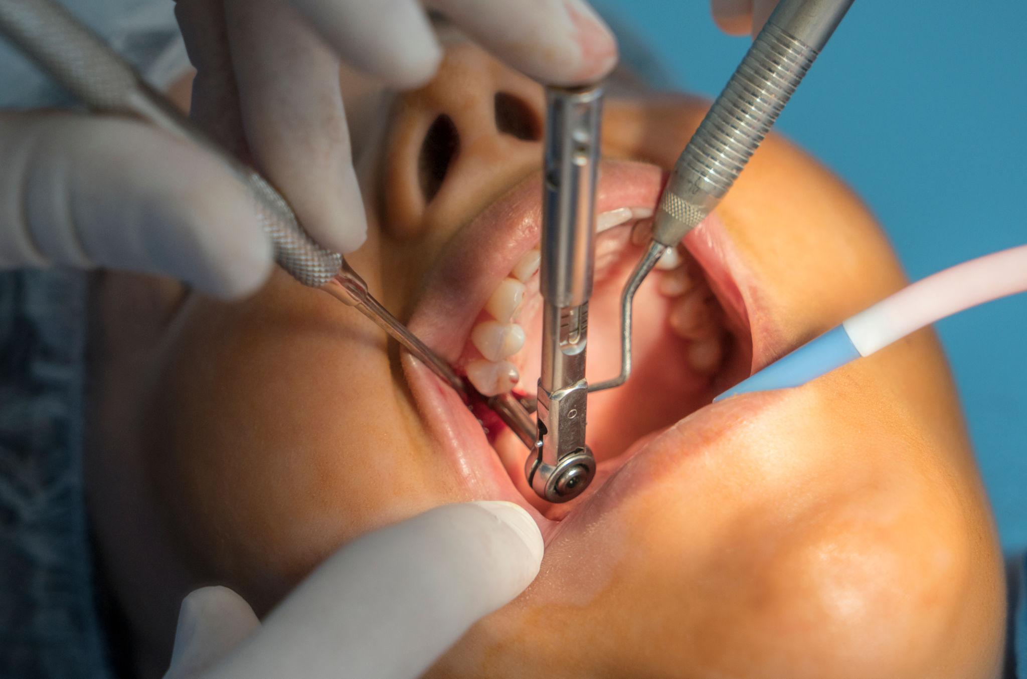 Single-Tooth Dental Implants Treatment in North Carolina