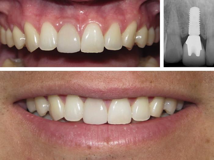 Single-Tooth Dental Implants in Durham