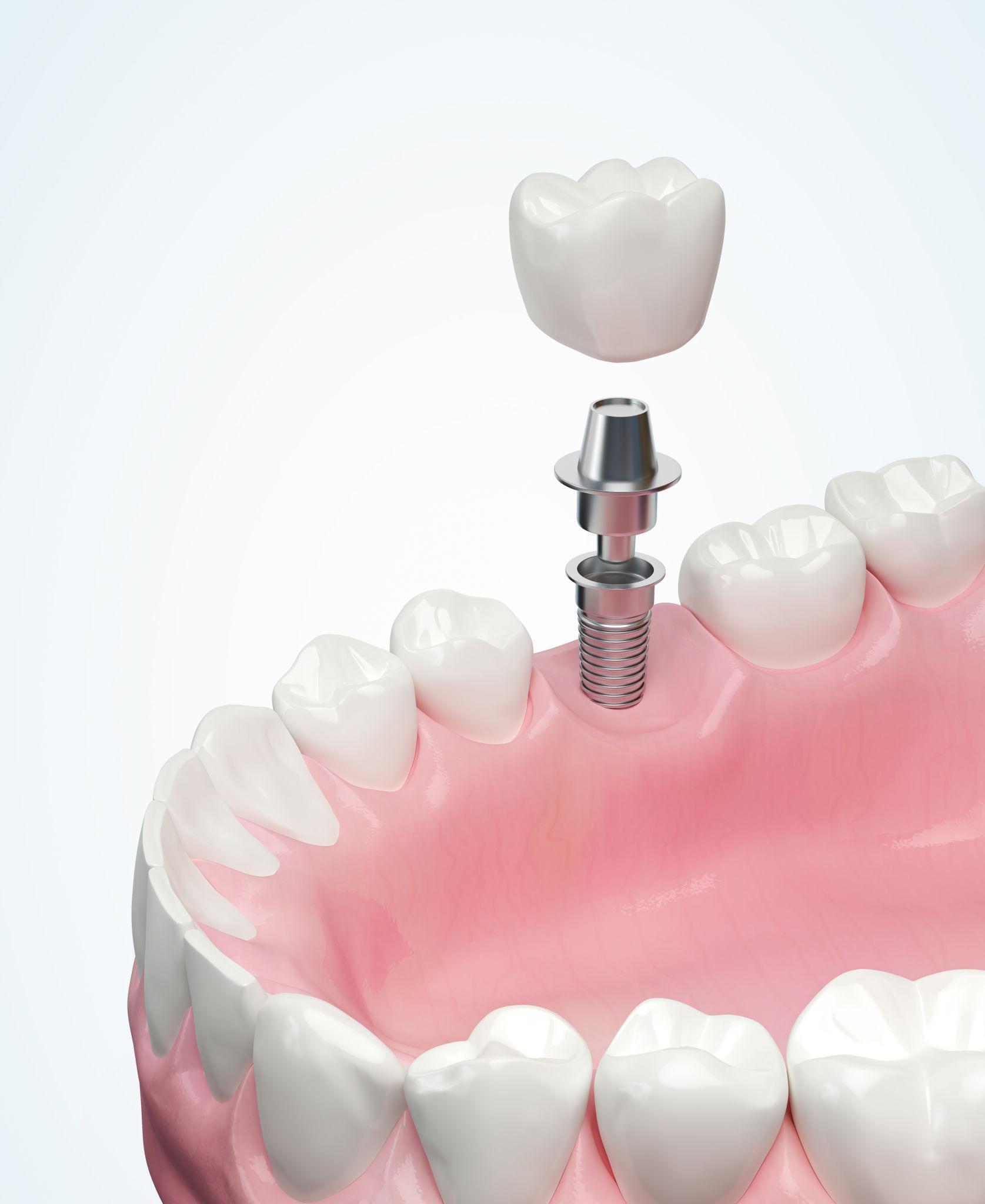 Single-Tooth Dental Implants in Fayetteville NC