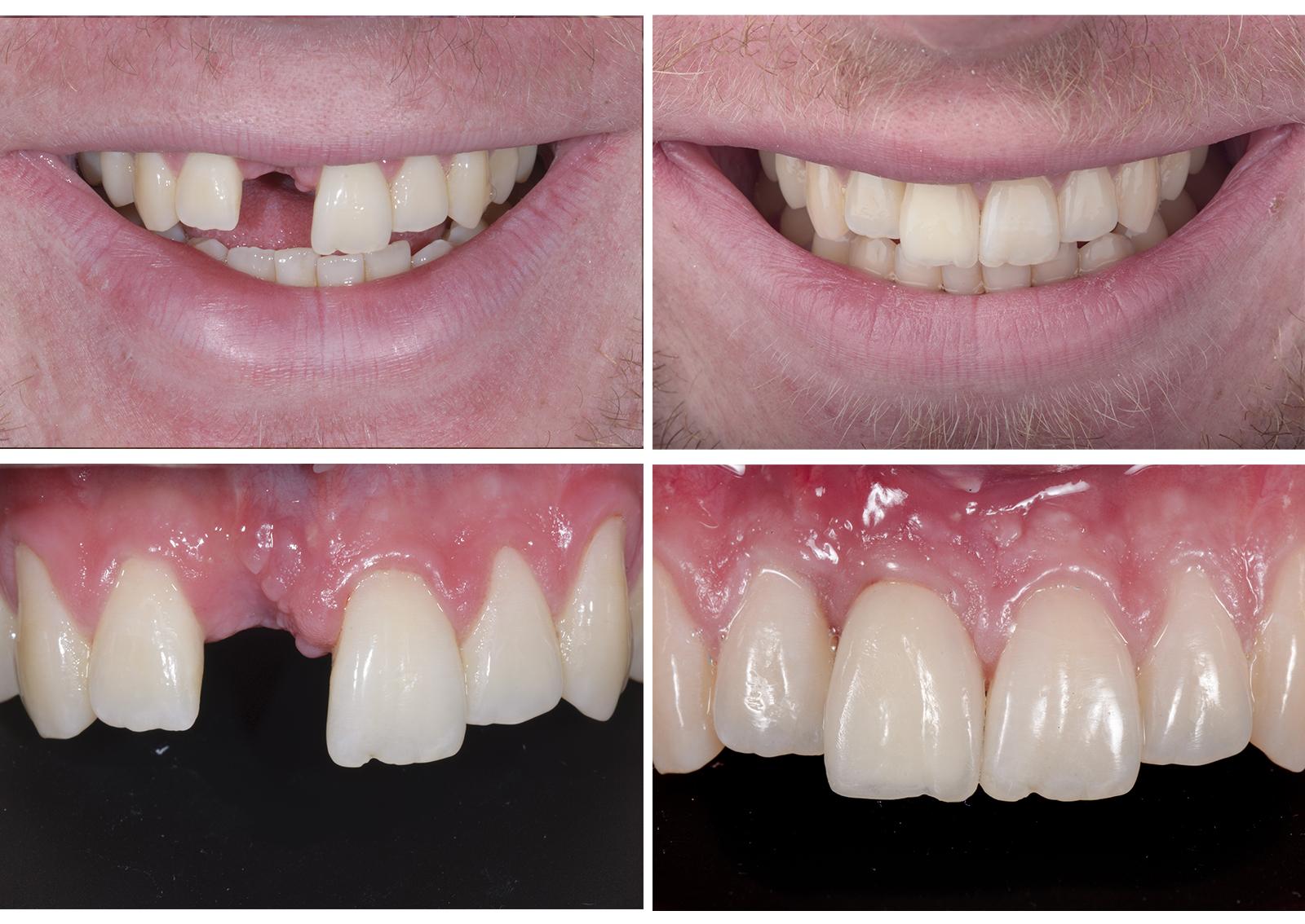 Single-Tooth Dental Implants in North Carolina