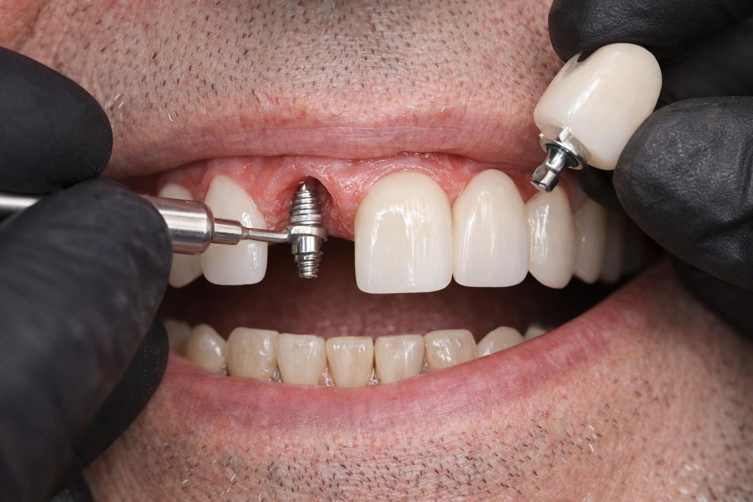 Single-Tooth Dental Implants in Siler City NC