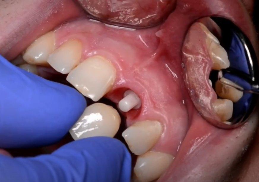 Single-Tooth Dental Implants in Siler City NC