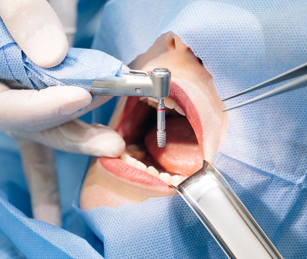 Single-Tooth Dental Implants in Southern Pines