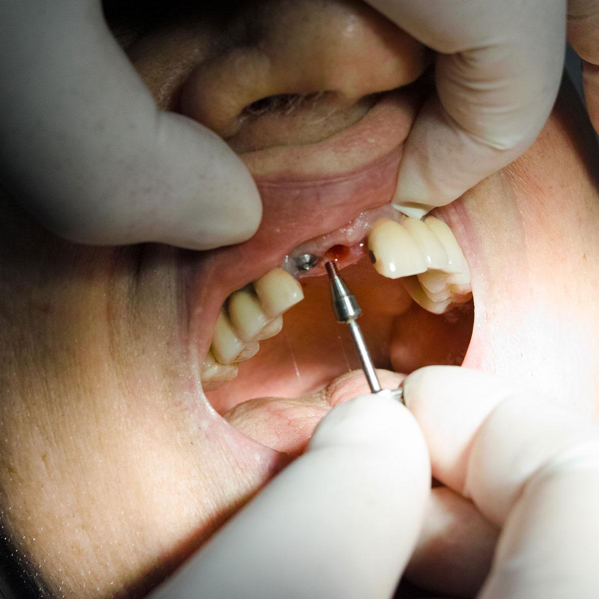Single-Tooth Dental Implants in Southern Pines NC