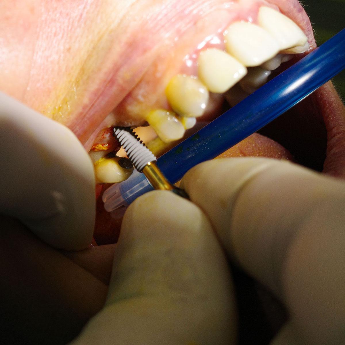 Single-Tooth Dental Implants in Wilmington NC