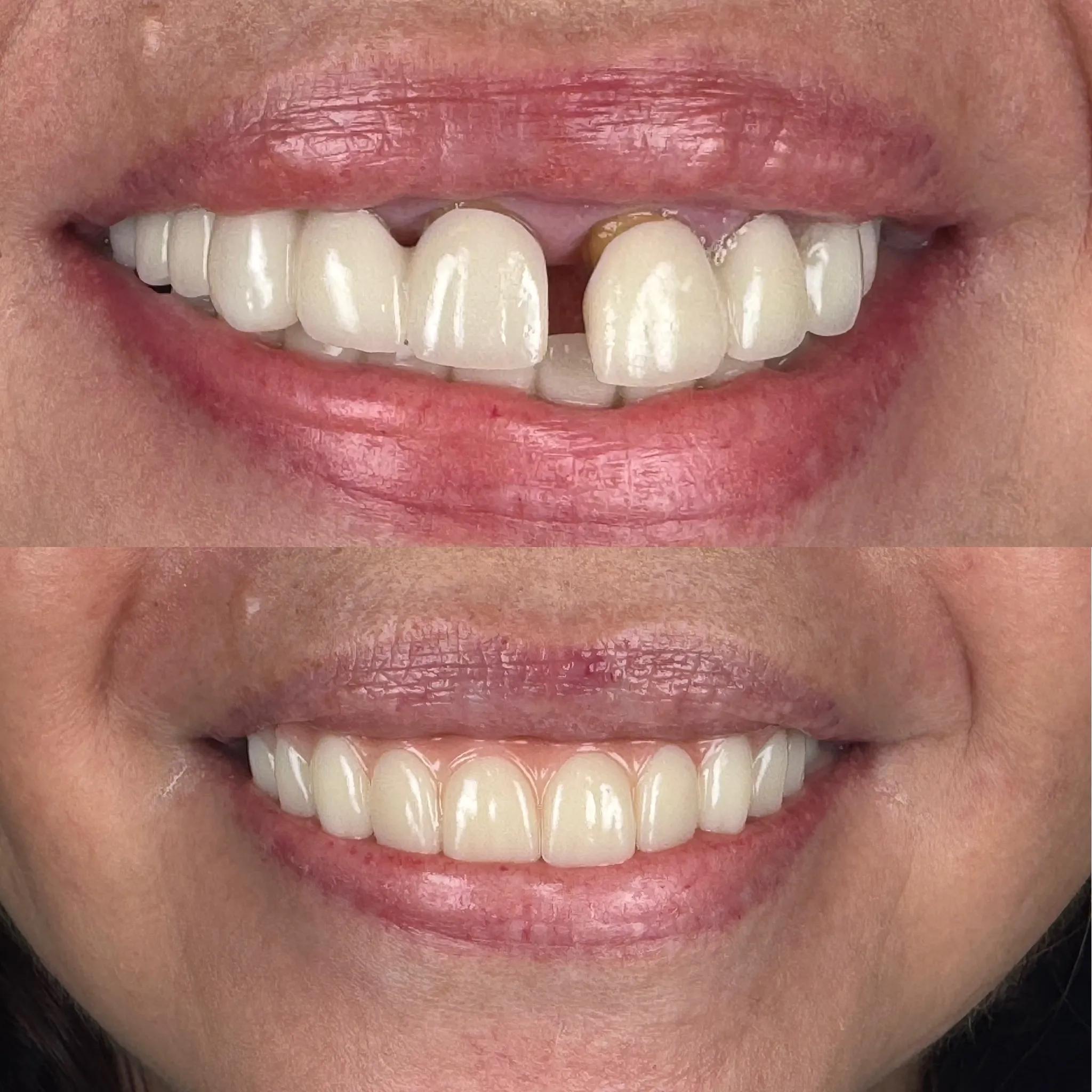 Single-Tooth Dental Implants in Wilmington