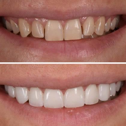 Smile Makeover Treatment in North Carolina