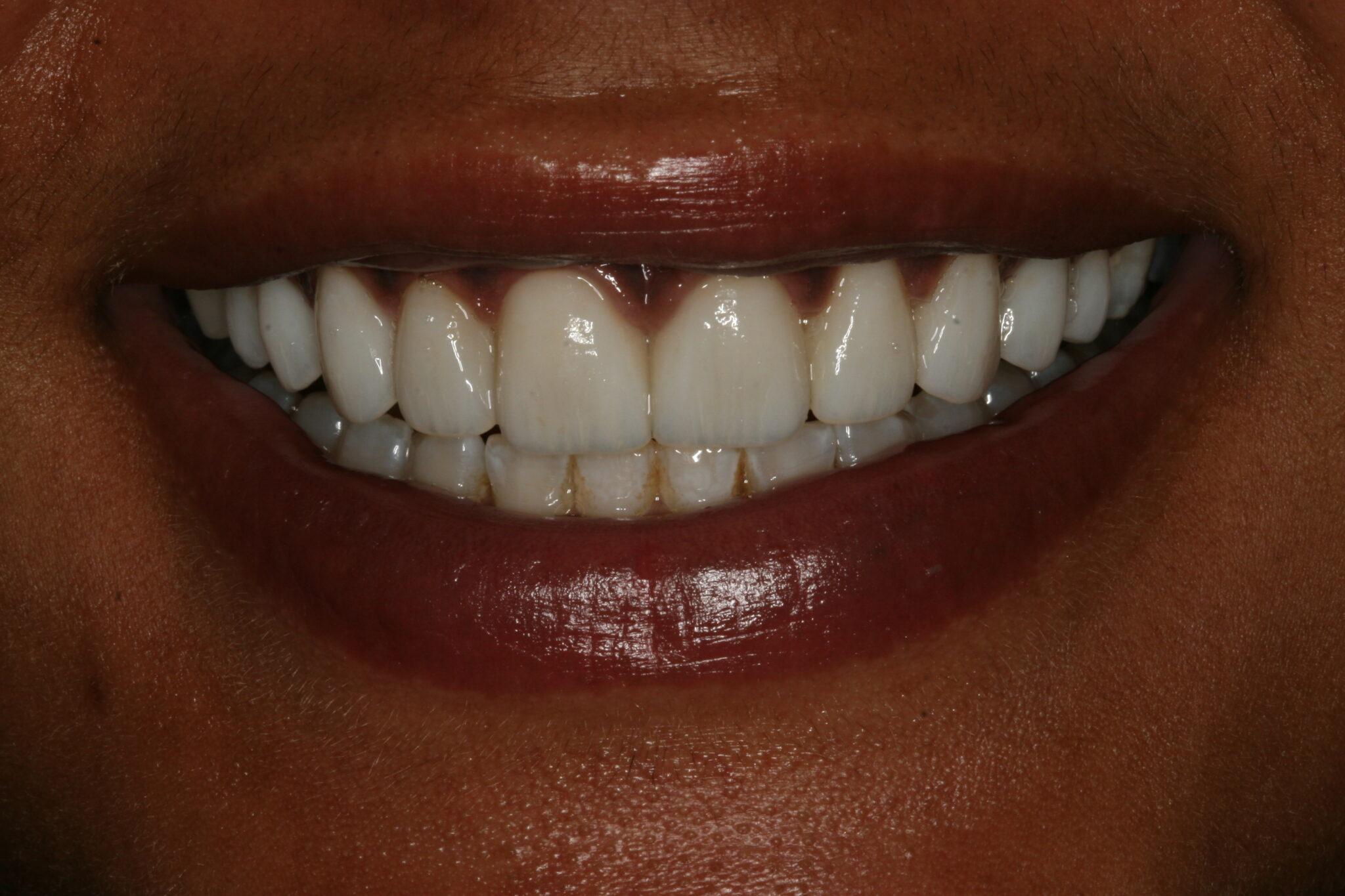 Smile Makeover in Fayetteville NC