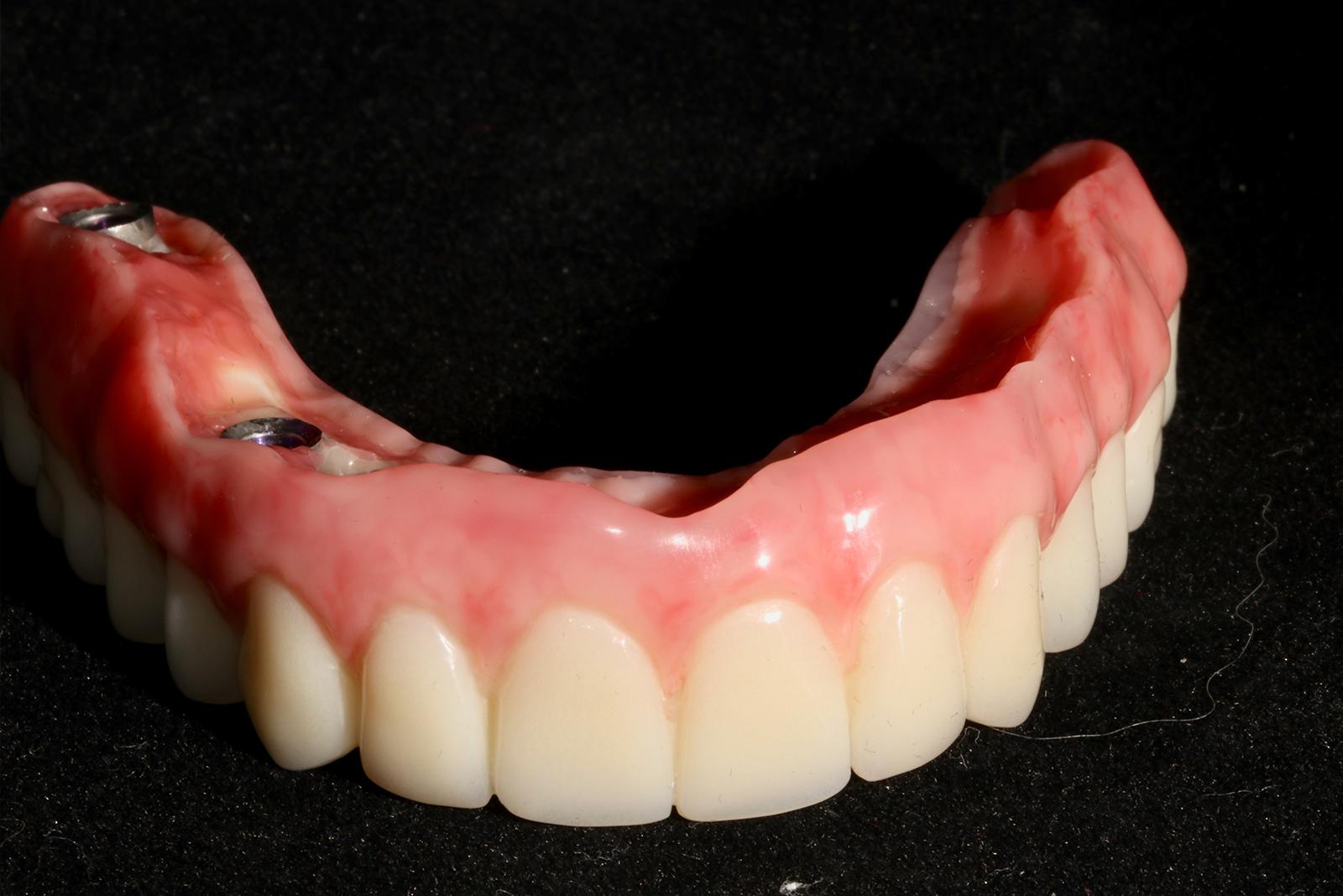 Snap-On Dentures NC