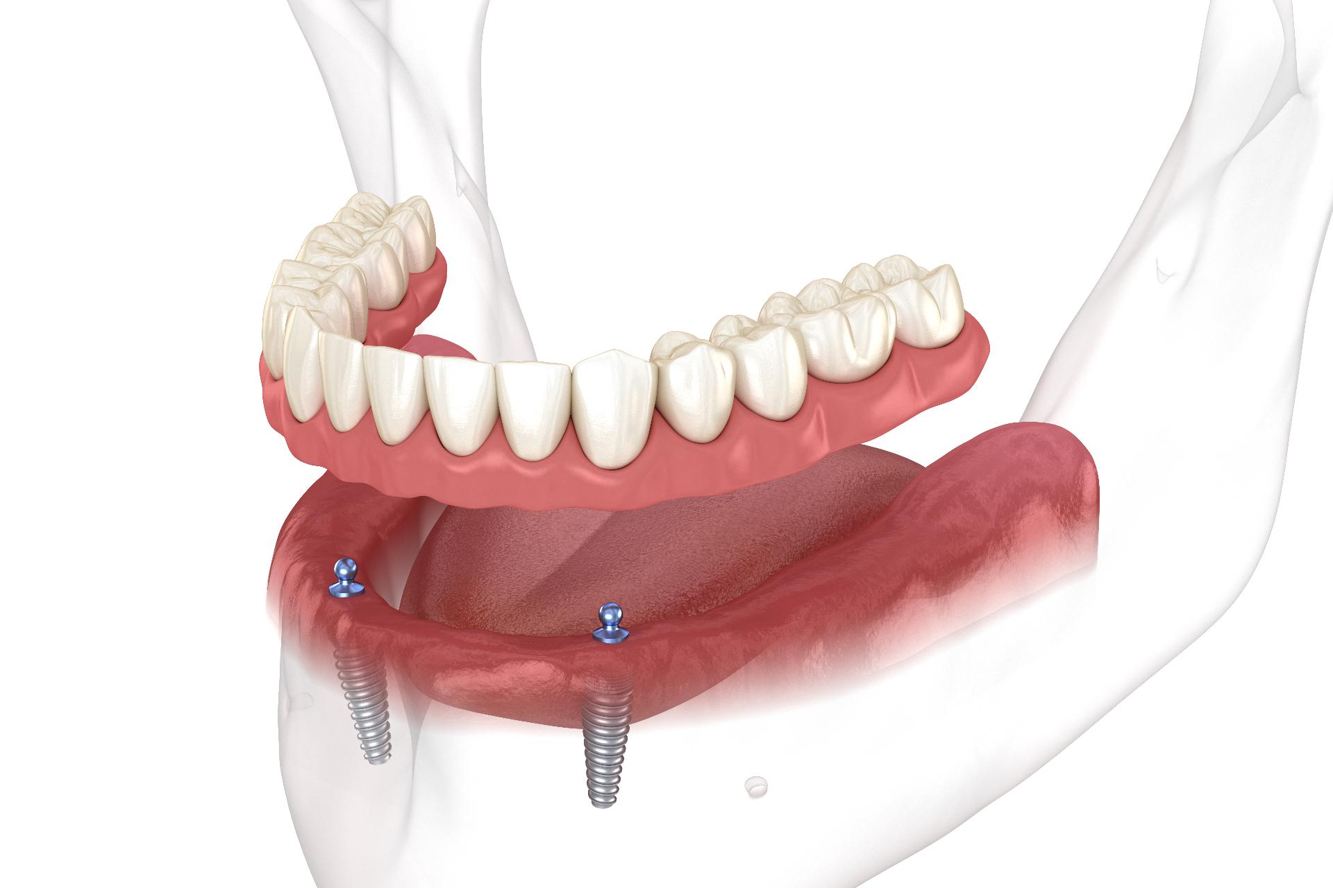 Snap-On Dentures Treatment in Siler City