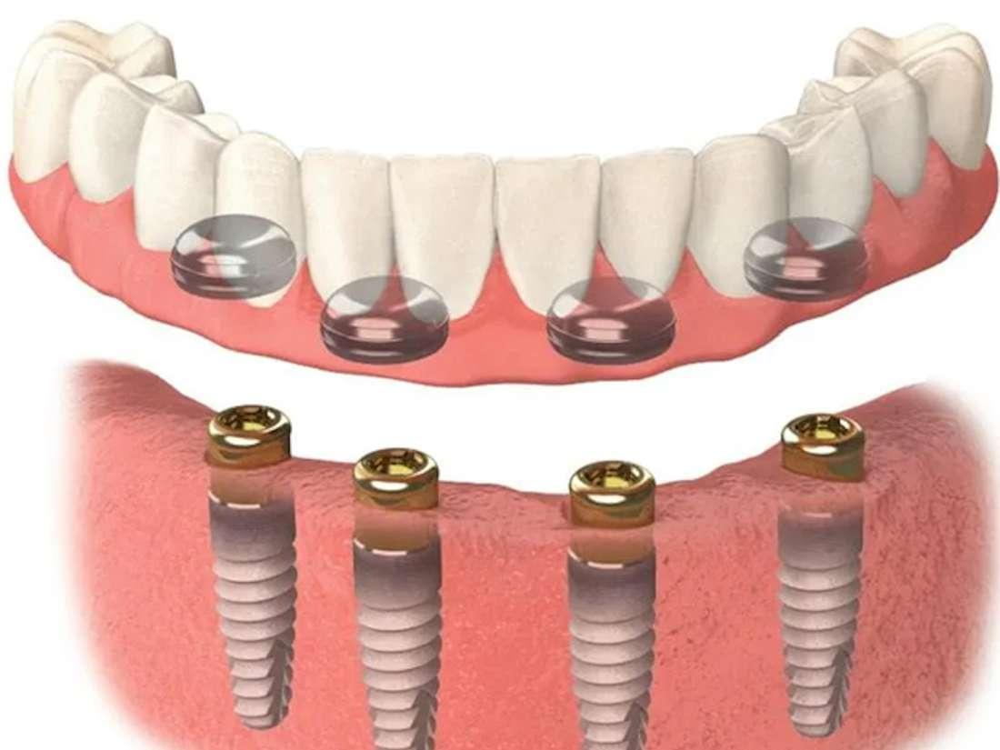 Snap-On Dentures in Durham ​