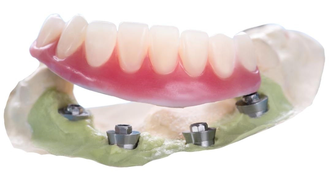 Snap-On Dentures in Raleigh NC