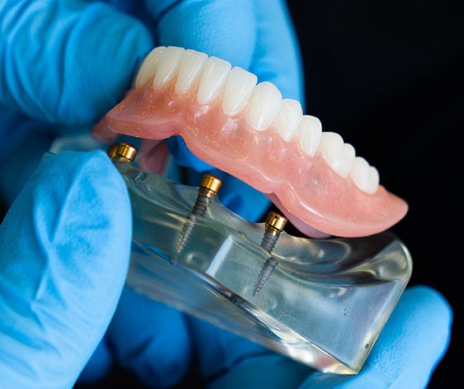 Dentaduras sobre implantes fayetteville
