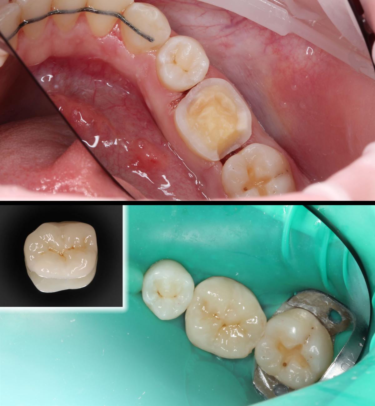 Dental Inlays and onlays in North Carolina