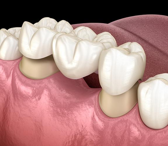 Puentes-dentales fayetteville