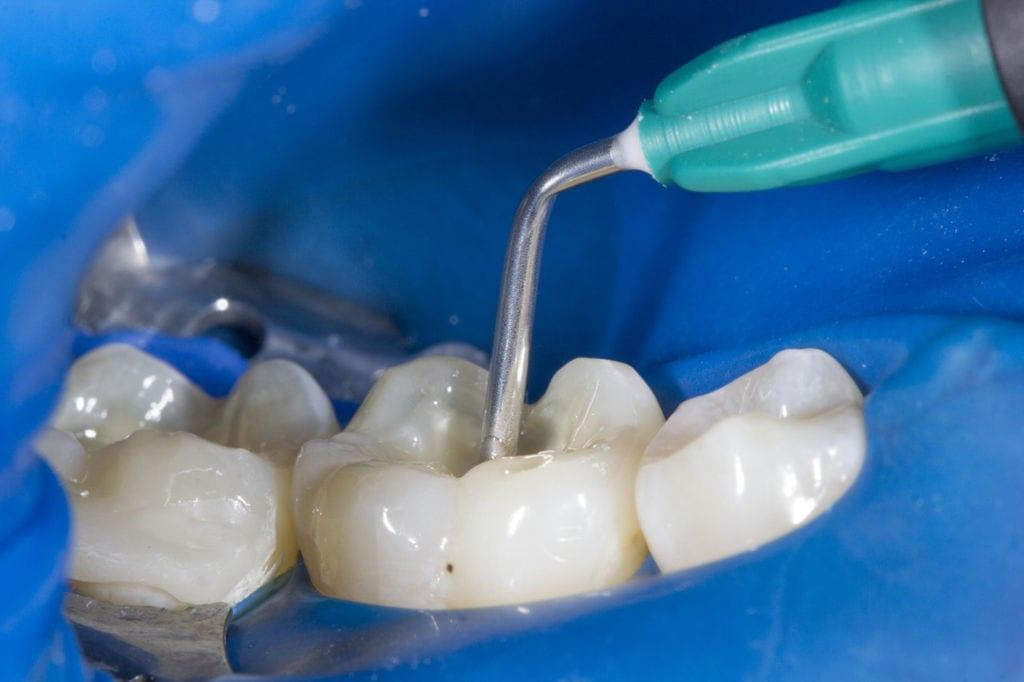 Rellenos dentales fayetteville