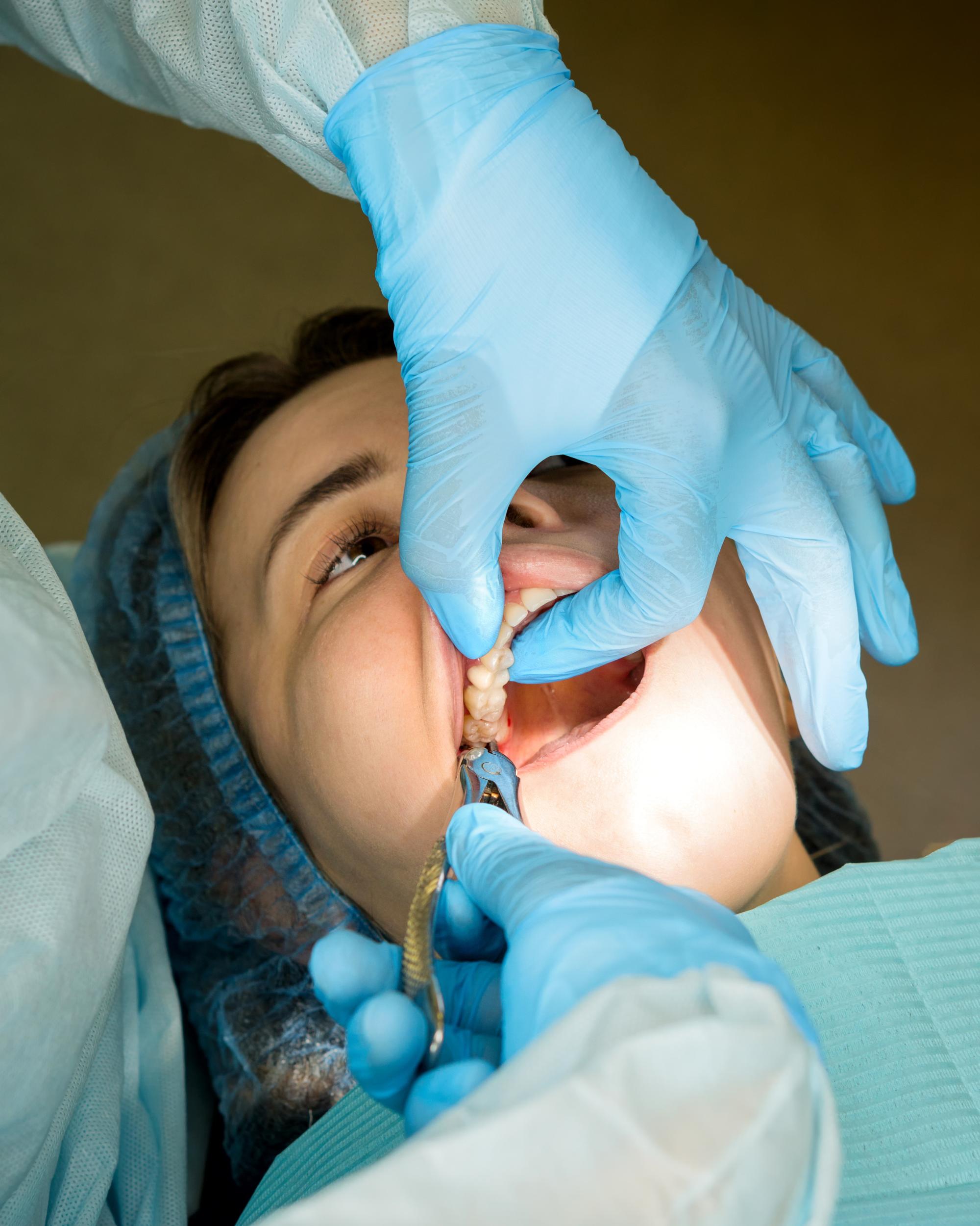 Tooth Extraction in North Carolina