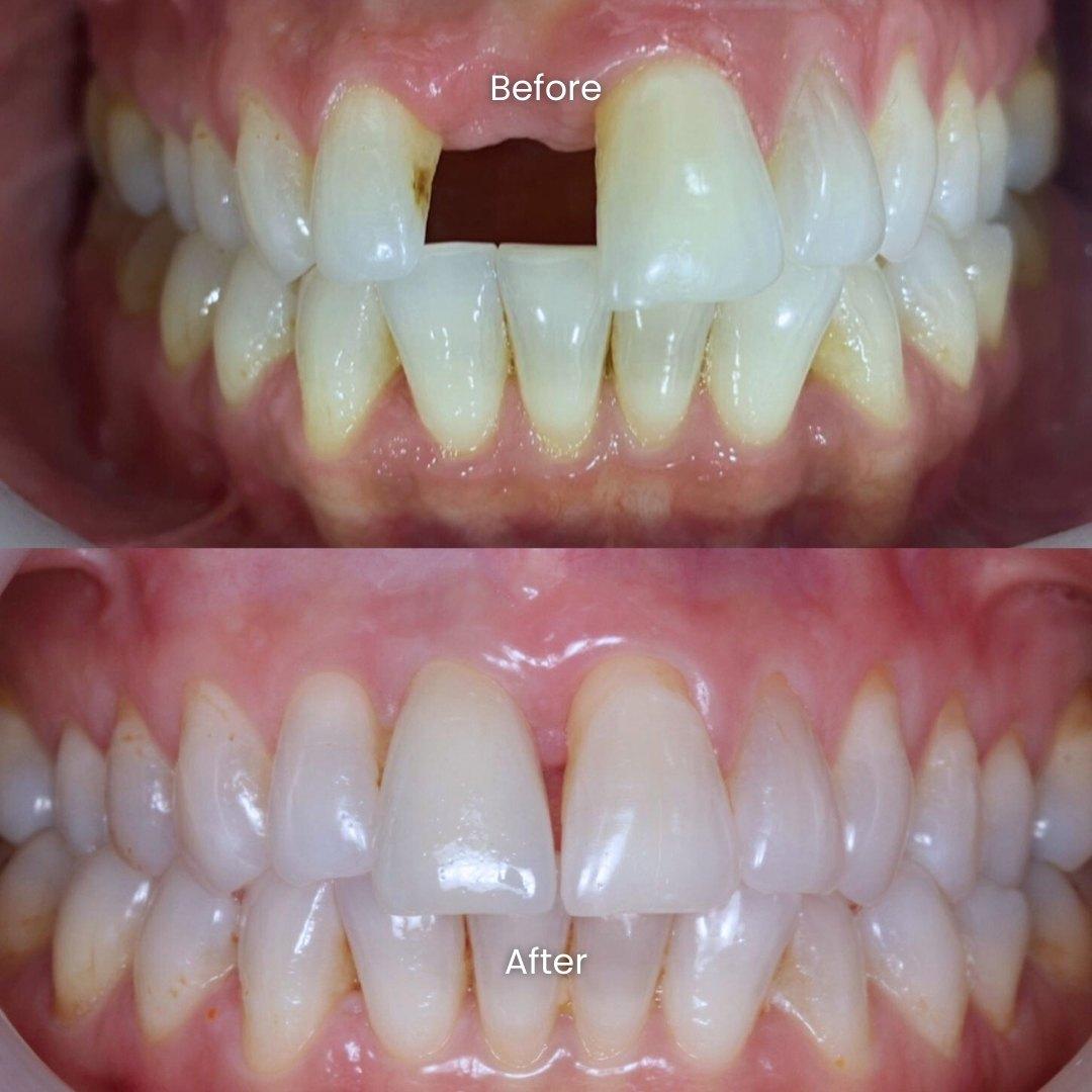 Before-and-after dental image showing repair of a missing upper front tooth with improved alignment and whitening after treatment